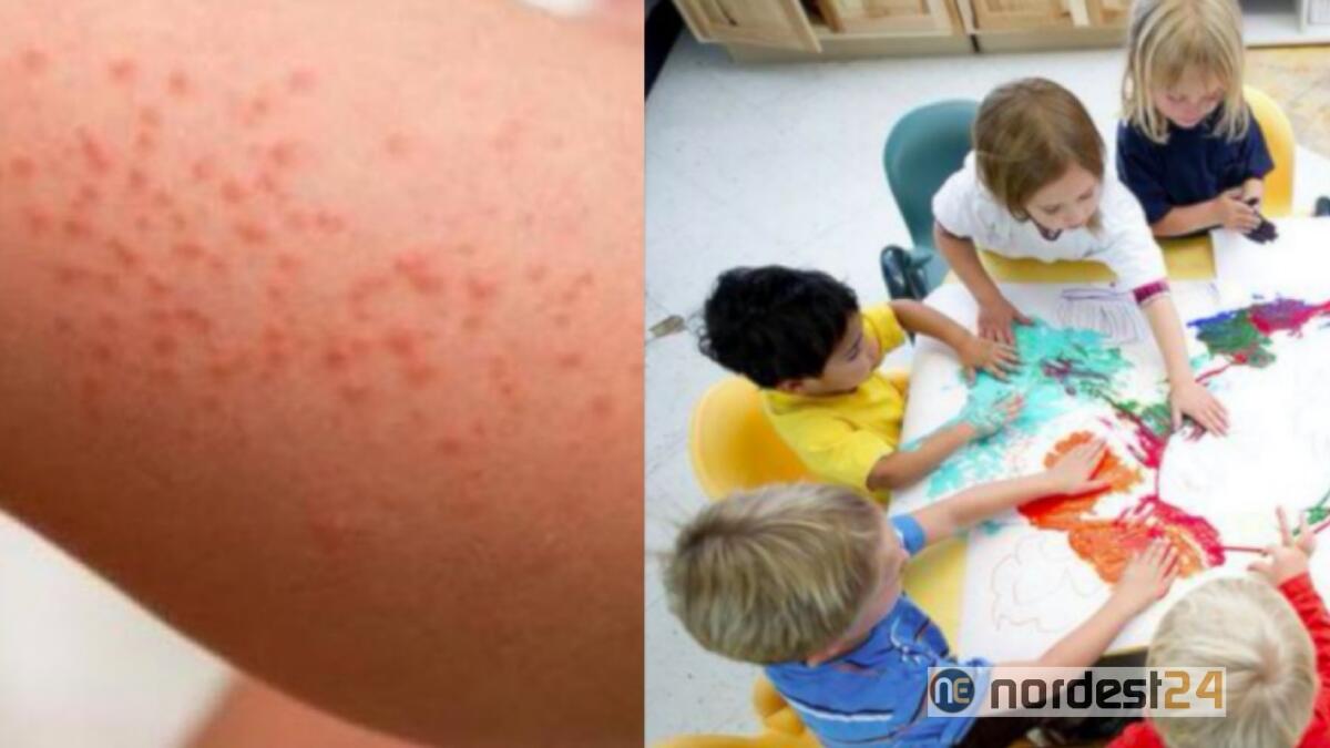 A Cividale un caso di scabbia alla scuola materna - 