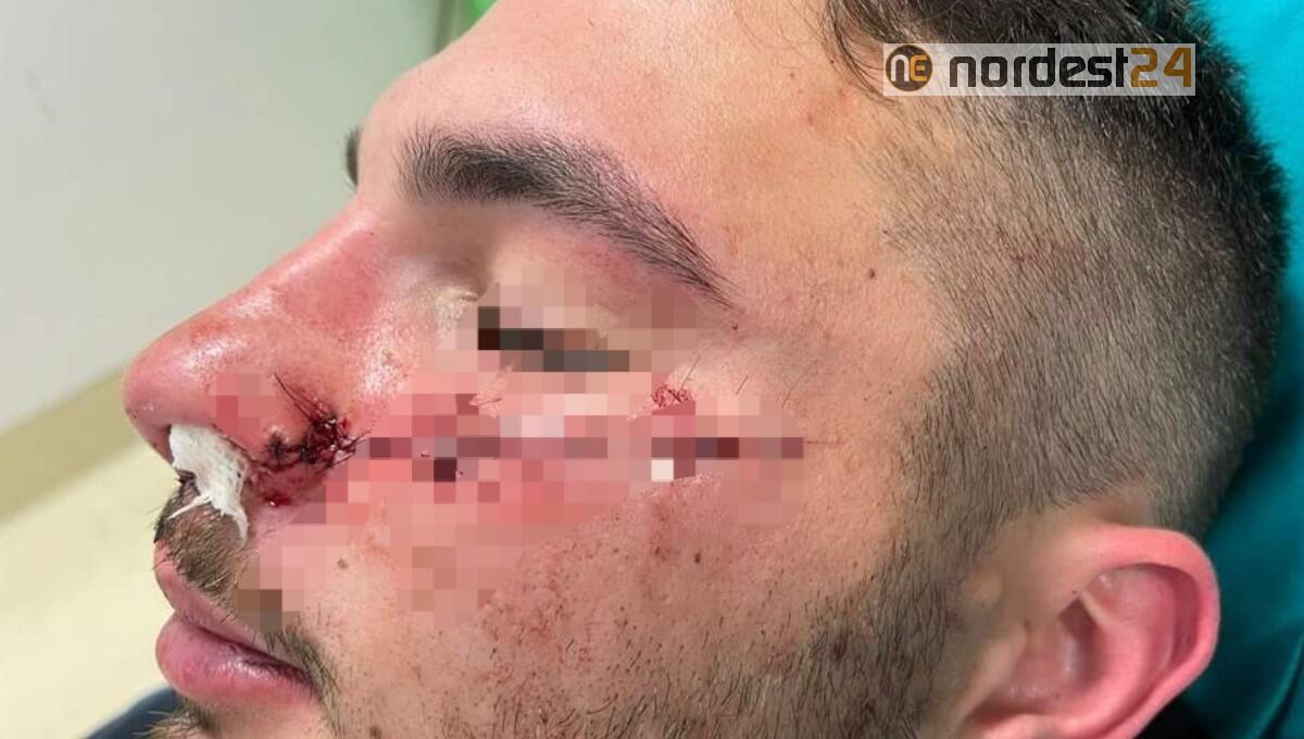 Rider sfregiato da un 16enne per difendere una ragazza - 