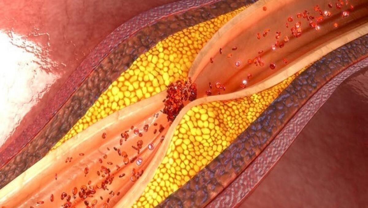 Chiusura delle coronarie: all'Ulss4 una tecnica innovativa ad onde d'urto - 