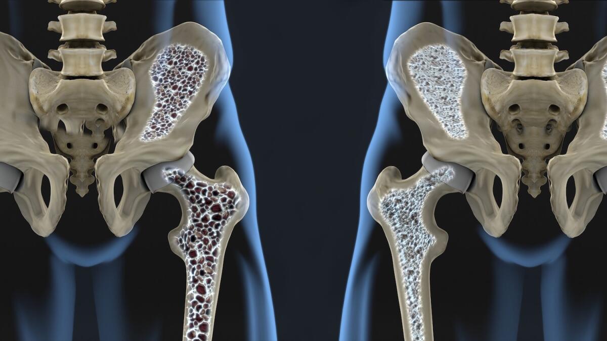 Osteoporosi e Covid-19: sottostima della malattia e fratture aumentate del 30% - 