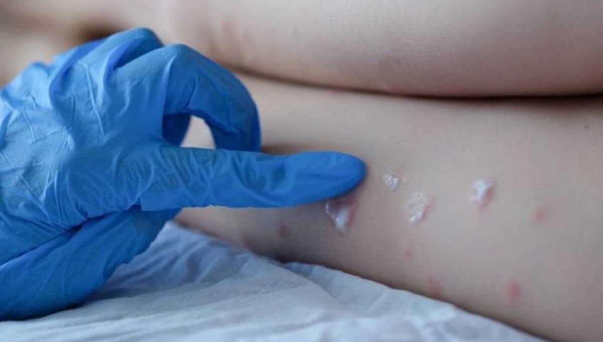 Riccardi: "Identificato un caso di vaiolo delle scimmie in Fvg" - 