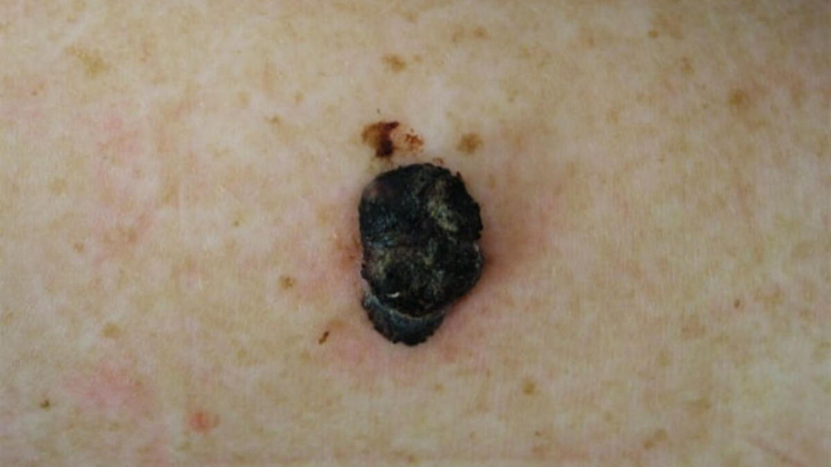 L’ASUFC in prima linea nella prevenzione contro il melanoma - 