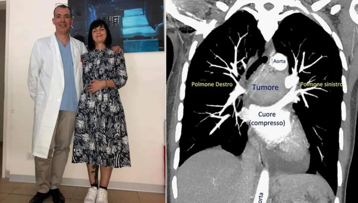 Un tumore schiacciava cuore e polmoni: rimosso con una straordinaria operazione - 