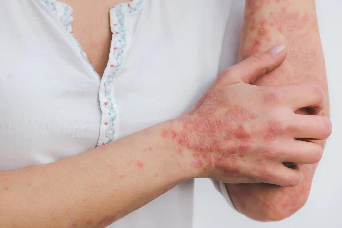 Psoriasi e dermatite atopica, a Trieste e Gorizia screening dermatologici gratuiti - 