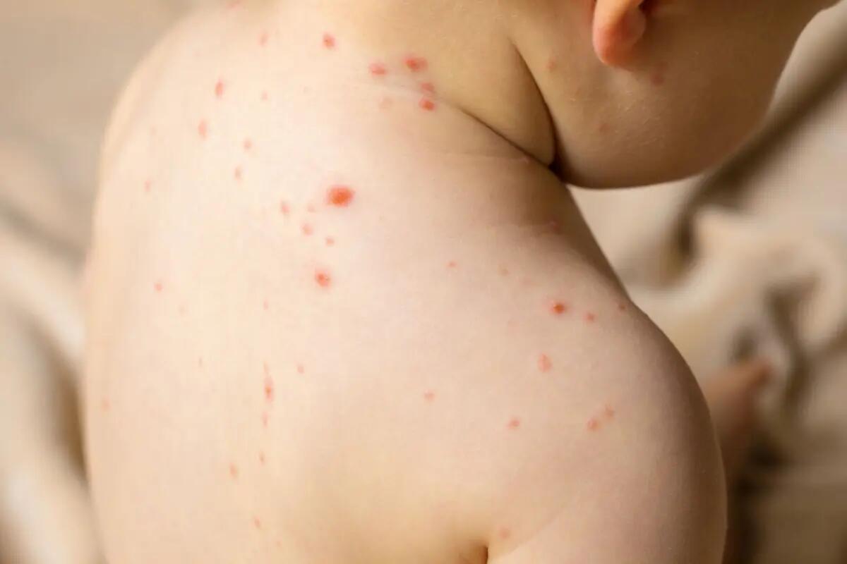 Il ritorno del morbillo in Friuli: chi colpisce, quanti casi e perché preoccupa - 