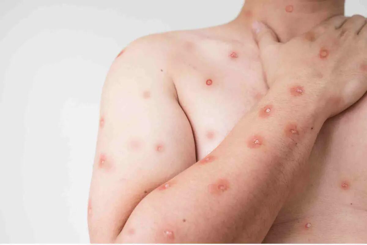 Vaiolo delle scimmie in Friuli, Riccardi «situazione sotto controllo». Gli aggiornamenti - 