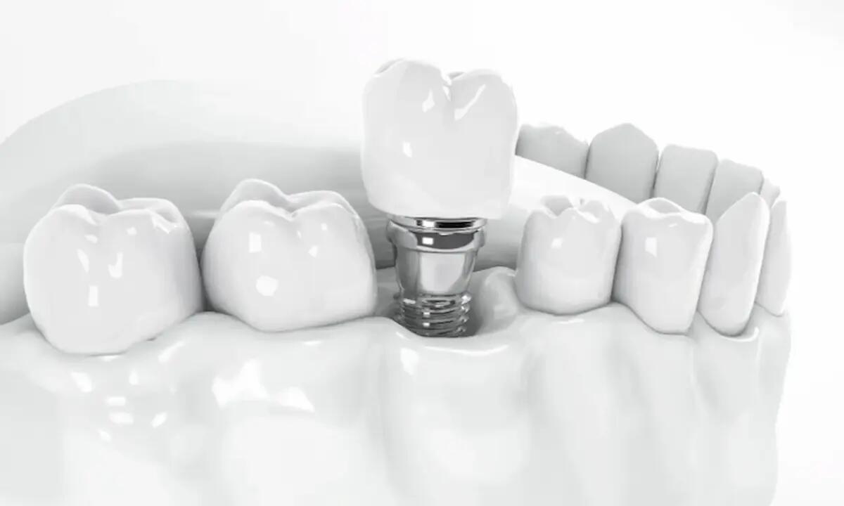 È possibile fare gli impianti dentali in Albania in un solo giorno? - 