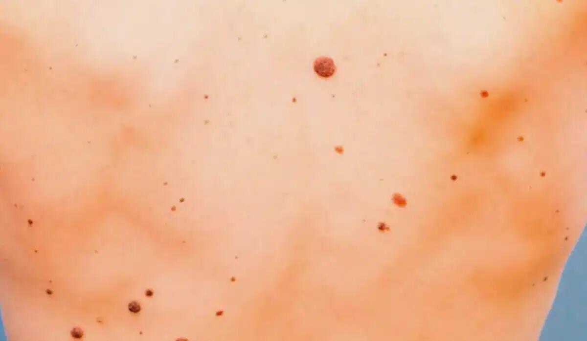 Mappatura dei nei: prevenzione a tutela della salute - 