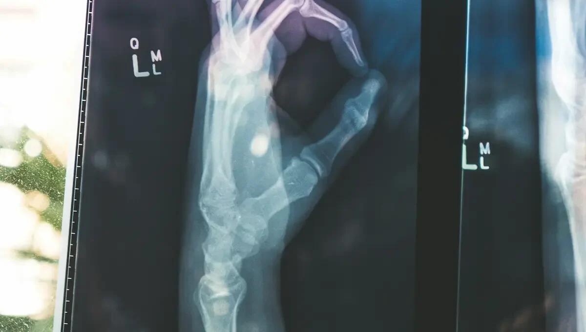Salute: stile di vita e dieta fattori cruciali per prevenire l’osteoporosi - 