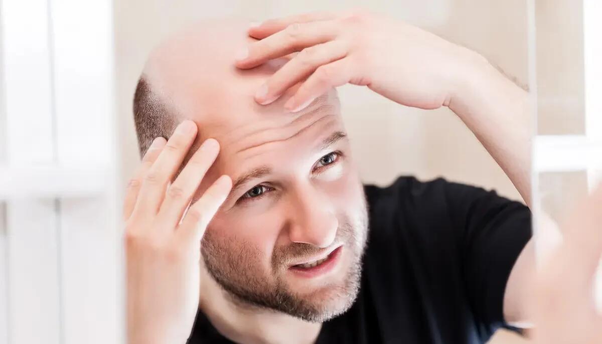 Perdita di capelli: rimedi contro la calvizie - 