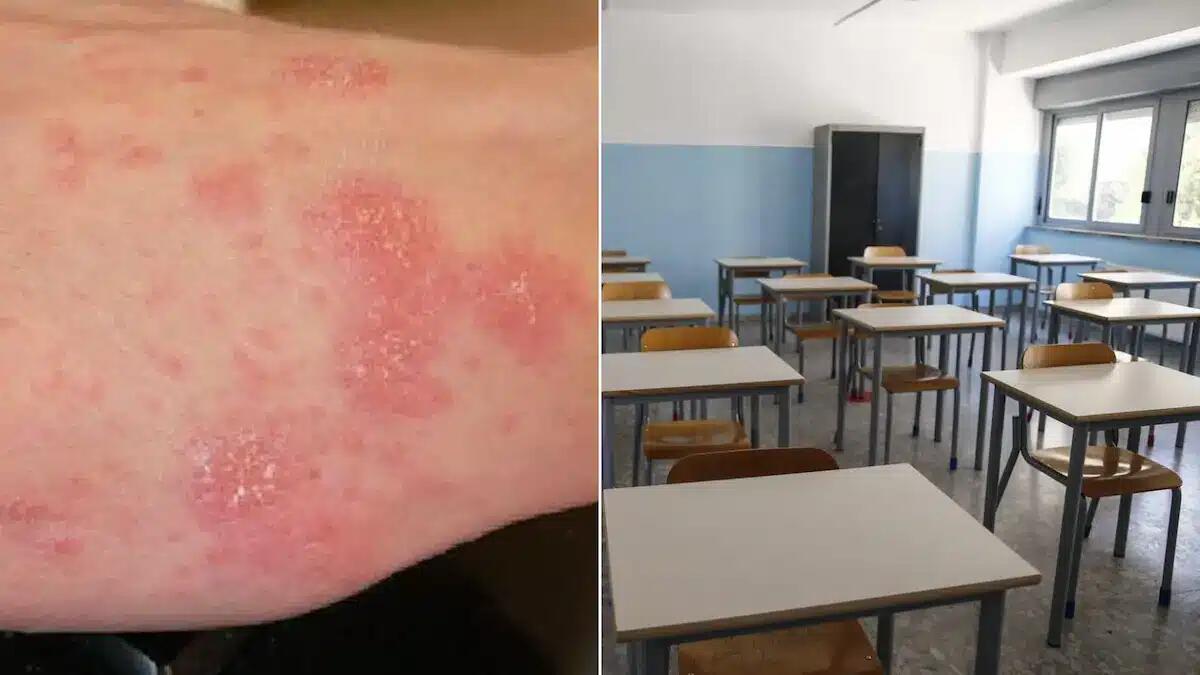 Quattro casi di scabbia nelle scuole di Monfalcone, scattano profilassi e sanificazione - 