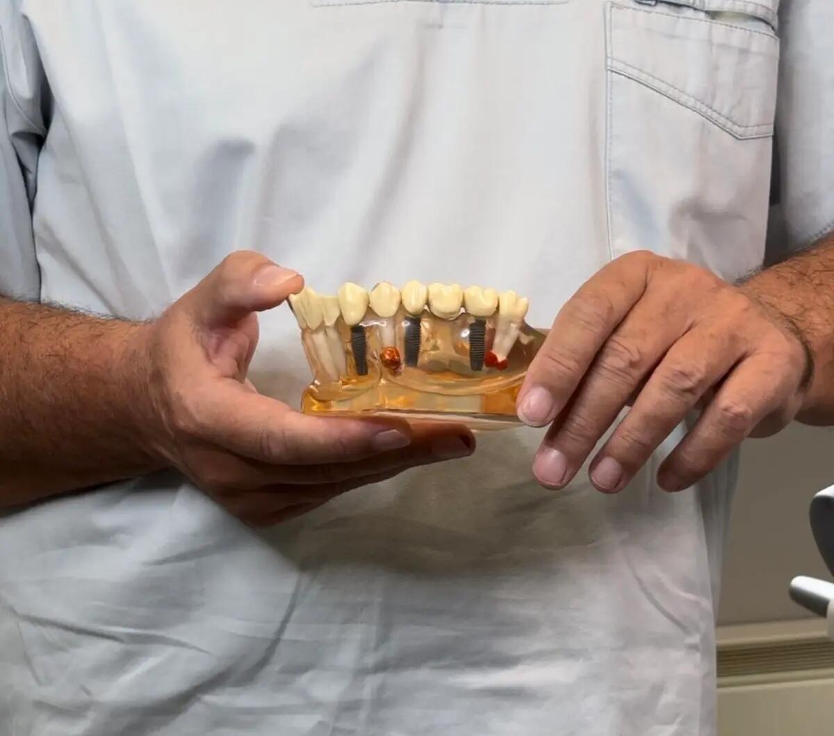 Impianti dentali a Ronchi dei Legionari, Udine e Trieste - 