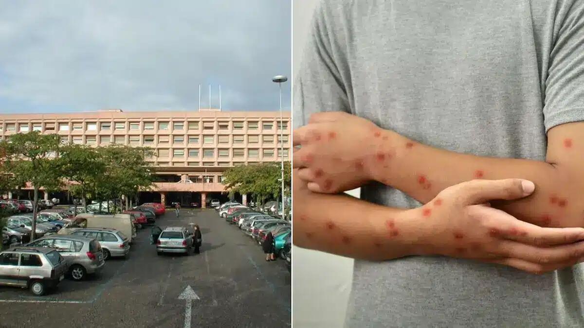 Udine, sette casi di "vaiolo delle scimmie": sei pazienti ricoverati e uno in isolamento - 