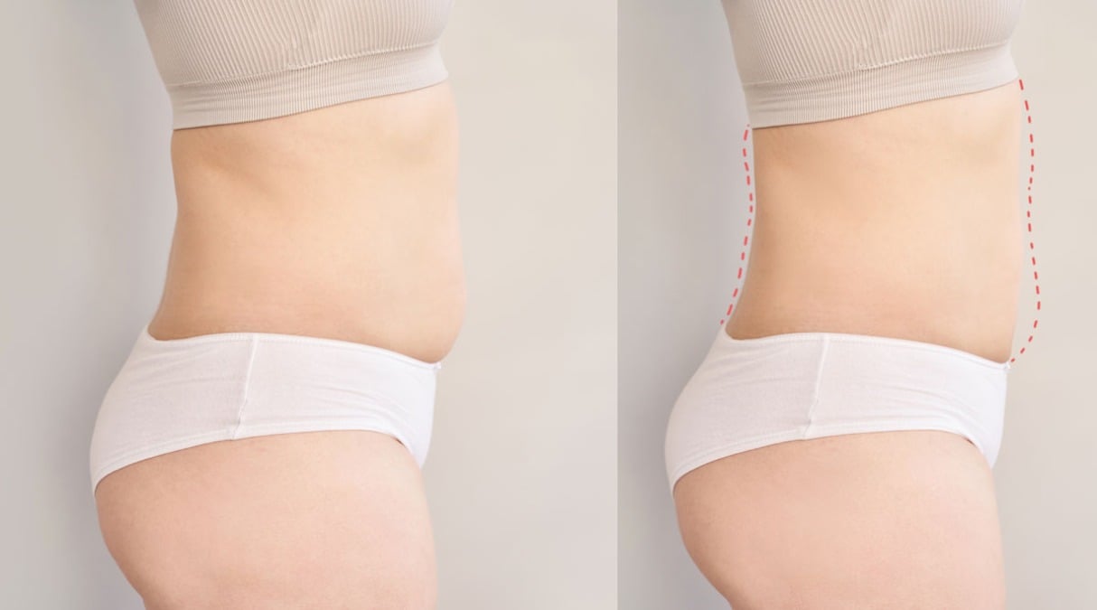 Liposuzione o dieta? Il Dr. Alessandro Dall’Antonia spiega finalmente cosa funziona davvero per migliorare il corpo - 