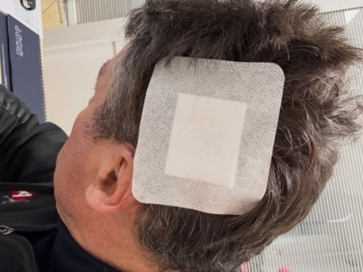 Investito da un'auto sulle strisce, ex campione olimpico finisce in ospedale - Profilo Facebook: Silvio Martinello