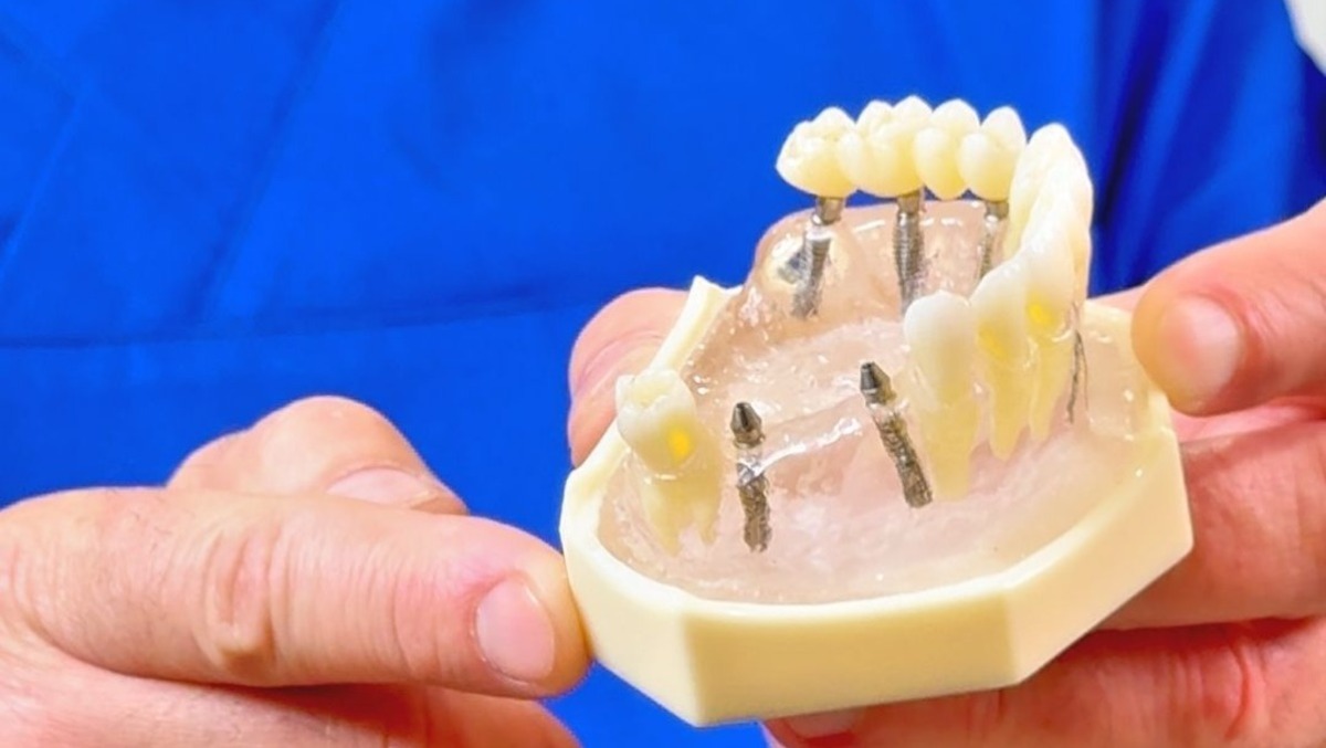 Impianto dentale a Pisa: chi è il candidato ideale per l’implantologia dentale - 