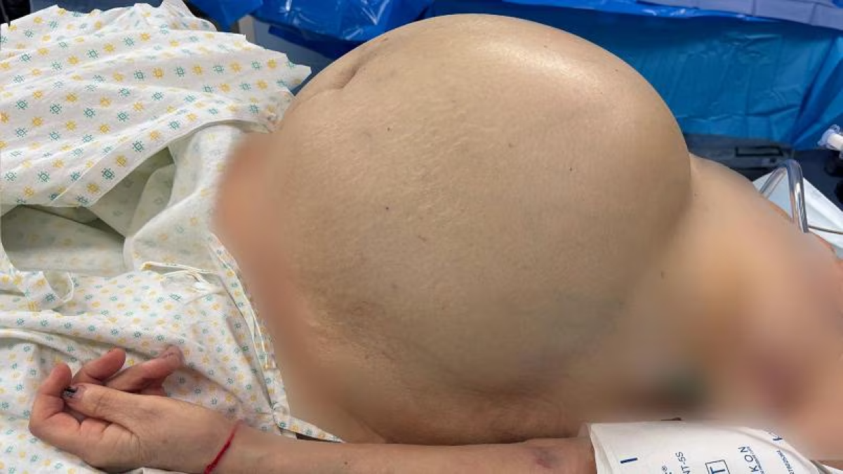 Miracolo chirurgico in Veneto: rimossa cisti ovarica di 50kg a una donna - Ansa