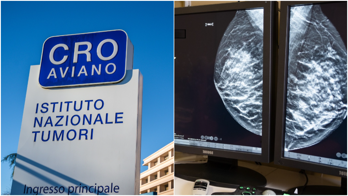 Tumore al seno in FVG: in stadio precoce la sopravvivenza a 10 anni supera il 90% - 